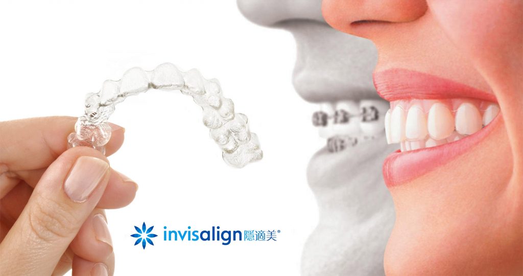 Invisalign隱適美