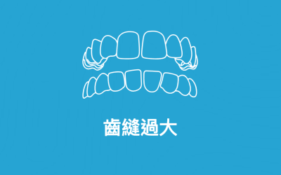 Invisalign_06